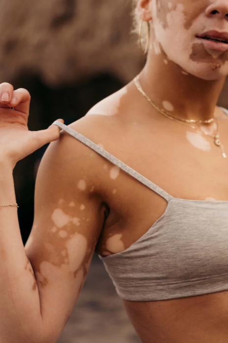 Woman with visible skin condition wearing a gray tank top against a blurred background