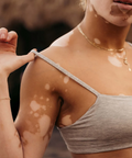 Woman with visible skin condition wearing a gray tank top against a blurred background